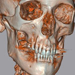 Volume rendering of teeth and jaw bones. Cone-beam tomographic scan. Feldkamp reconstruction.