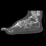 MIP view of a tomographic image of a human foot