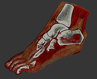 Volume rendered image of the foot (CT scan has been acquired on a cone-beam system)